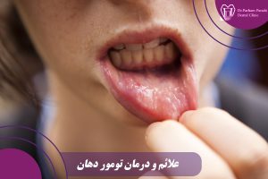 تومور دهان