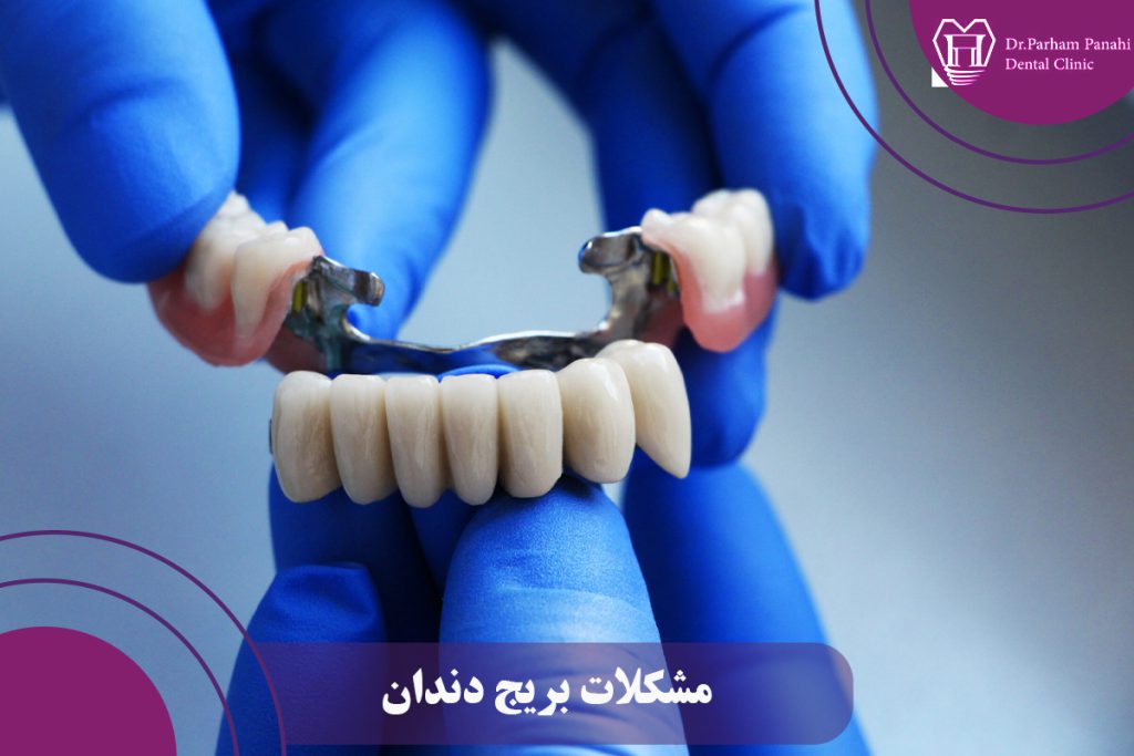 مشکلات بریج دندان