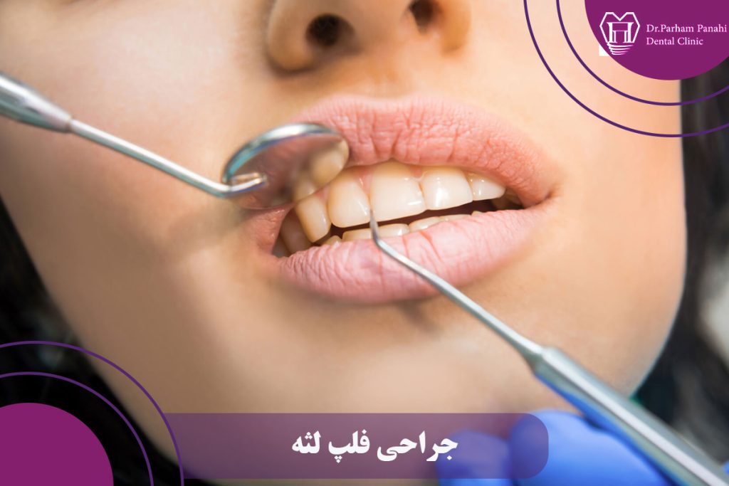 جراحی فلپ لثه