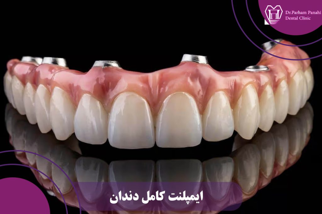 ایمپلنت کامل دندان