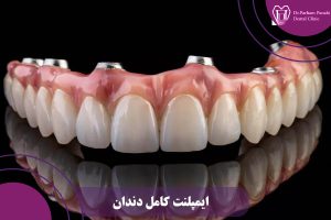 ایمپلنت کامل دندان