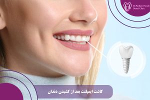 کاشت ایمپلنت بعد از کشیدن دندان