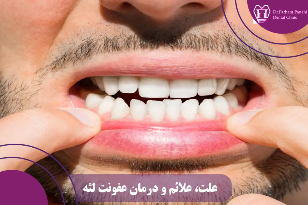 عفونت لثه