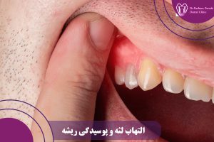 التهاب لثه و پوسیدگی ریشه
