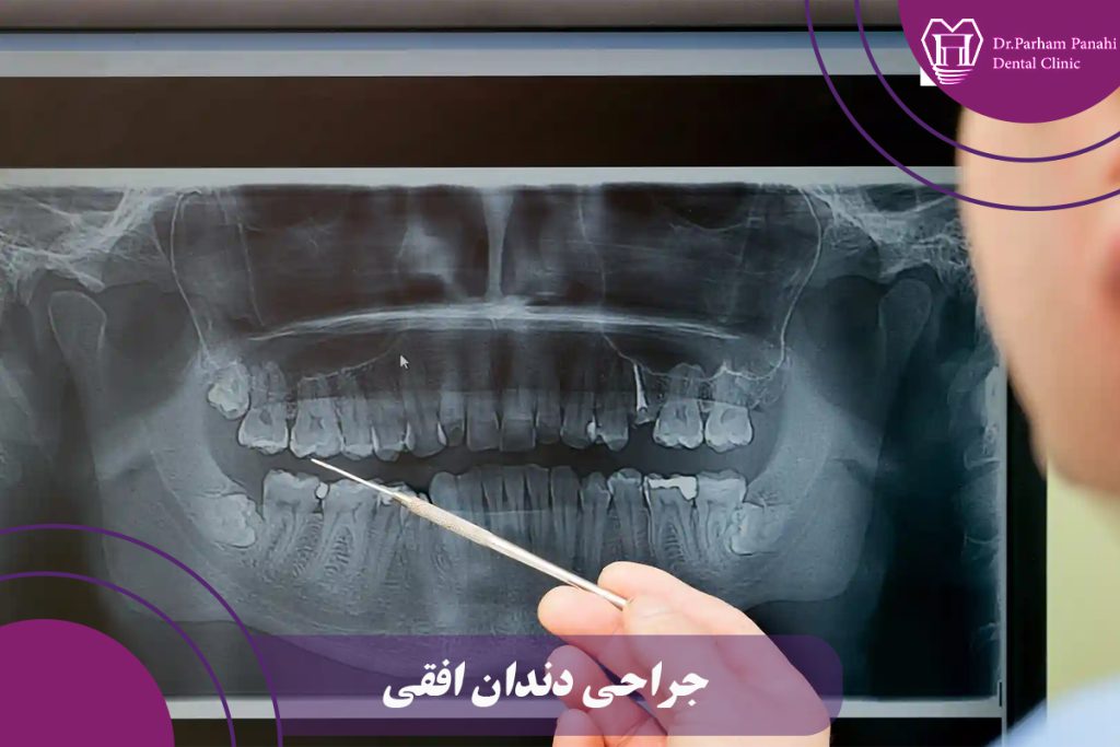 جراحی دندان افقی