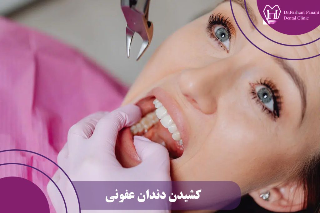 کشیدن دندان عفونی