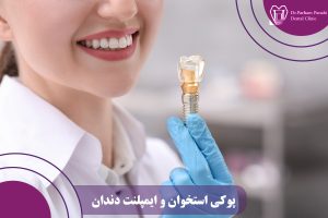 پوکی استخوان و ایمپلنت دندان