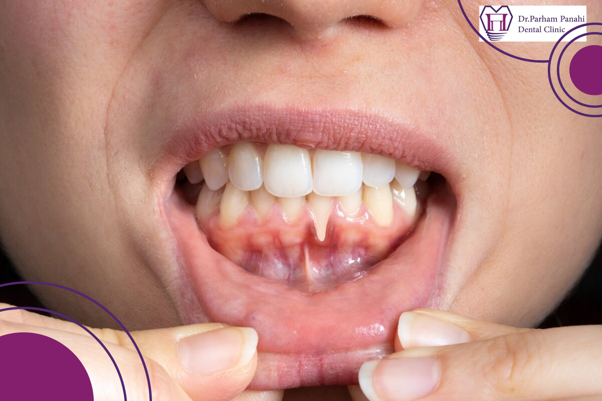 علائم التهاب لثه و پوسیدگی ریشه