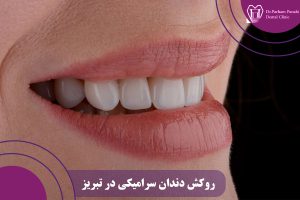 روکش دندان سرامیکی در تبریز