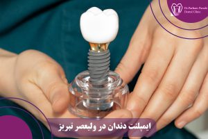 ایمپلنت دندان در ولیعصر تبریز