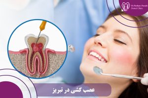 عصب کشی در تبریز