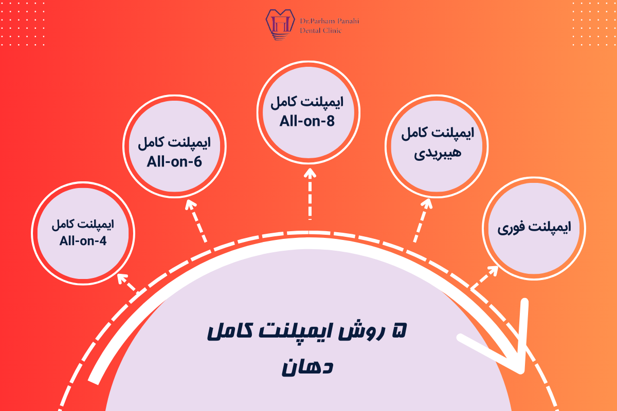 5 روش ایمپلنت کامل دهان 