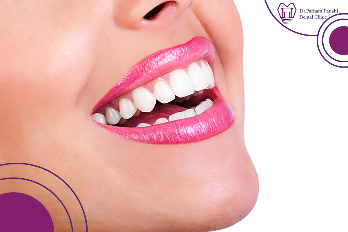 طول عمر روکش سرامیکی