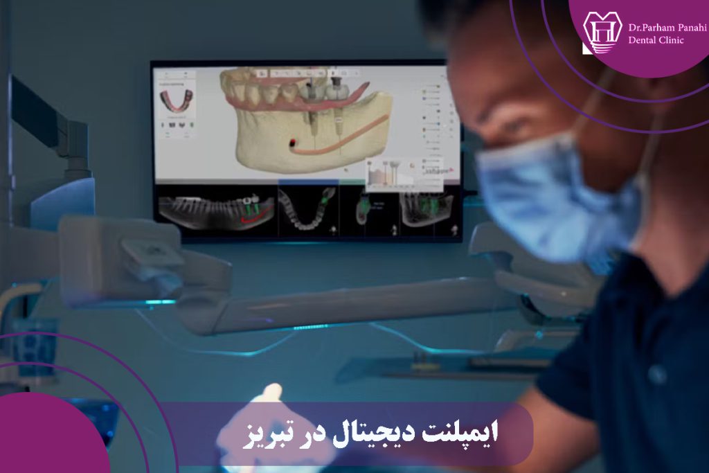 ایمپلنت دیجیتال در تبریز
