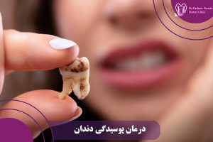 درمان پوسیدگی دندان