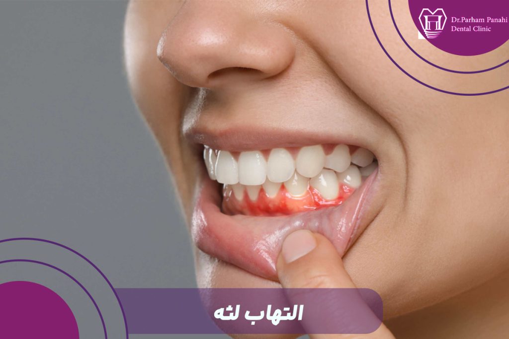 التهاب لثه