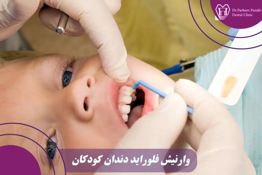 وارنیش فلوراید دندان کودکان