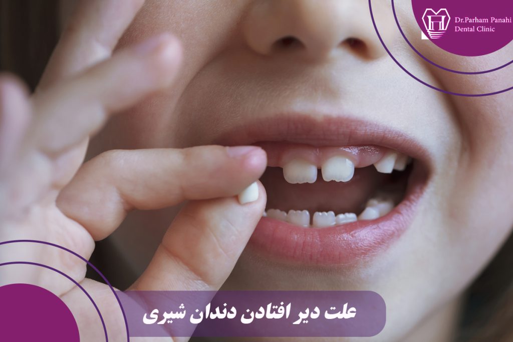 دیر افتادن دندان شیری