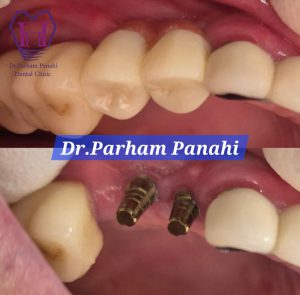 نمنوه ایمپلنت دندان در تبریز