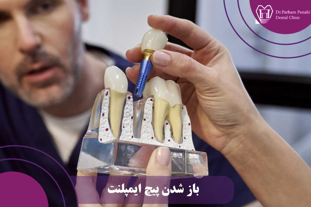 باز شدن پیچ ایمپلنت دندان