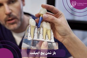 باز شدن پیچ ایمپلنت دندان