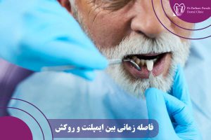 فاصله زمانی بین ایمپلنت و روکش