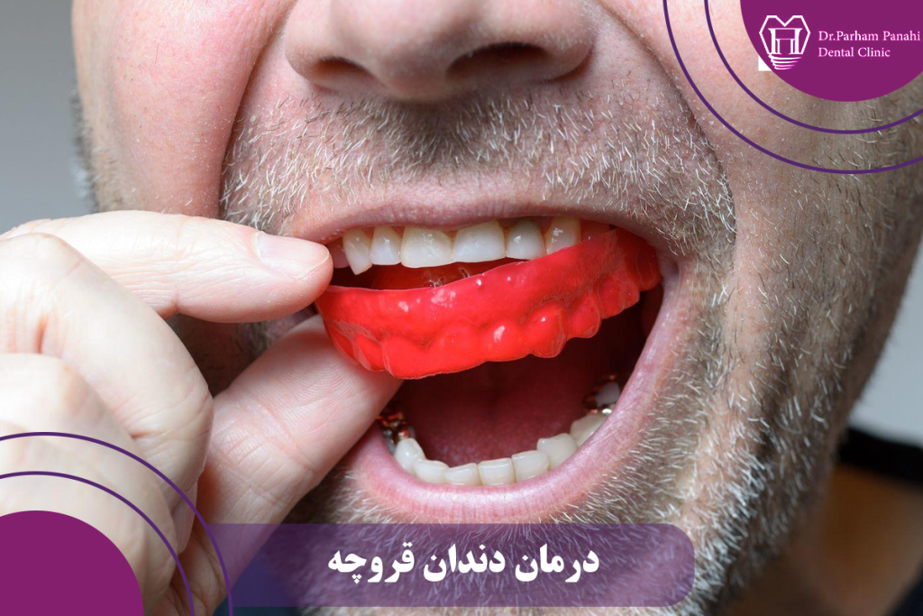 درمان دندان قروچه