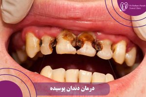 درمان دندان پوسیده