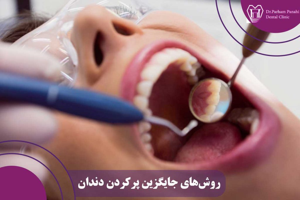 روش‌های جایگزین پرکردن دندان