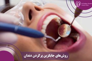 روش‌های جایگزین پرکردن دندان