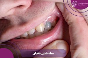 سیاه شدن دندان
