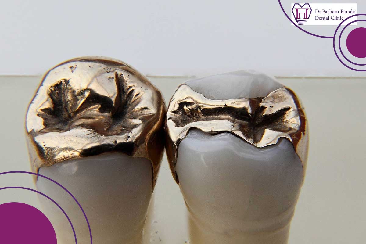 روشهای اینلی و آنلی