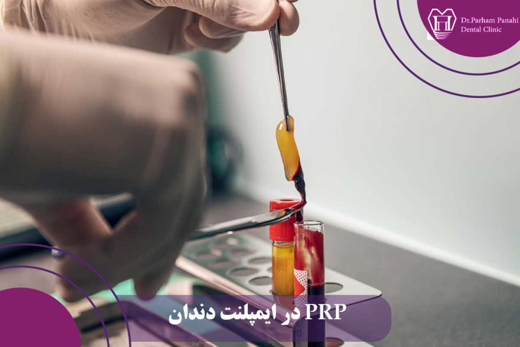 PRF در جراحی ایمپلنت