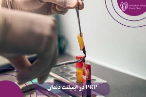 PRF در جراحی ایمپلنت