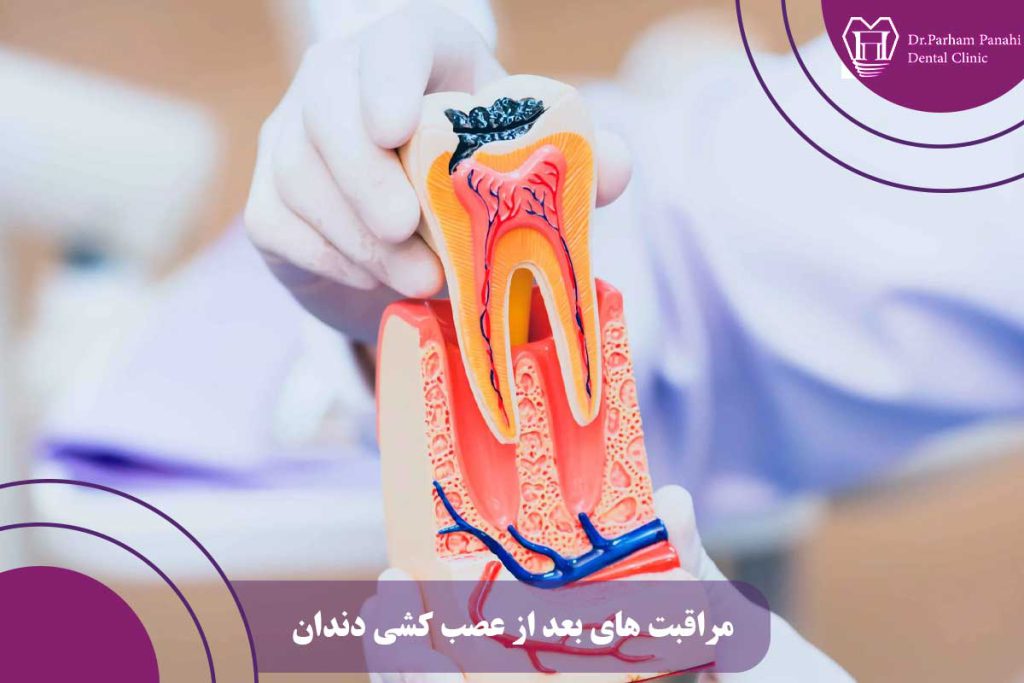 مراقبت های بعد از عصب کشی دندان