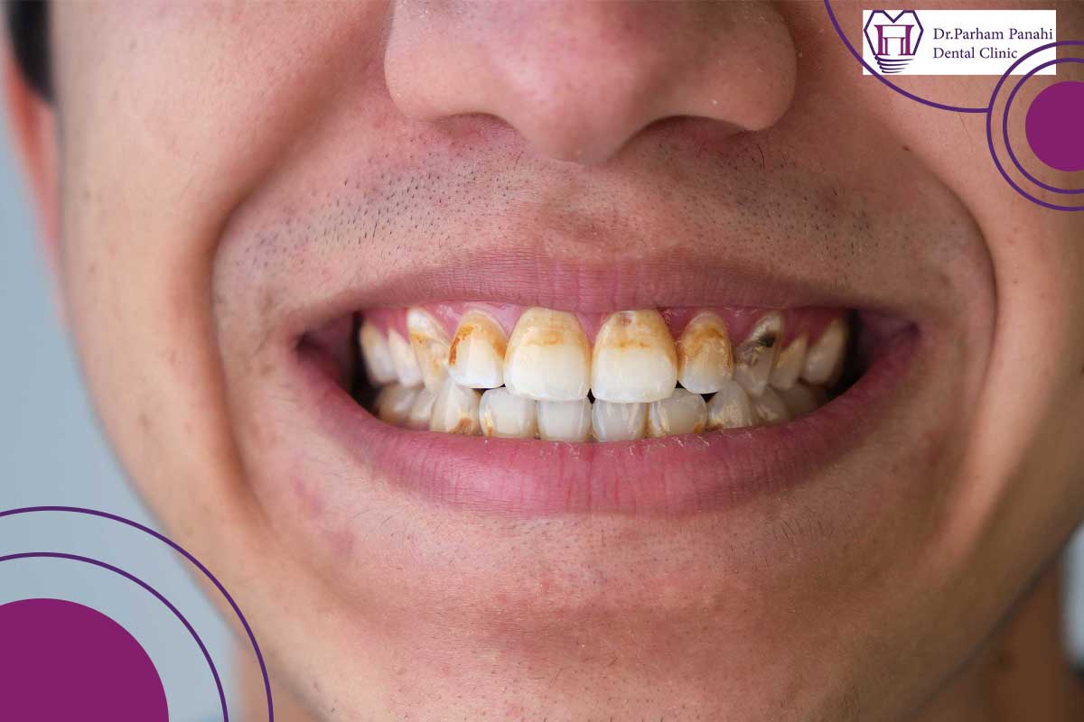 مضرات چوب مسواک
