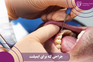جراحی لثه برای ایمپلنت