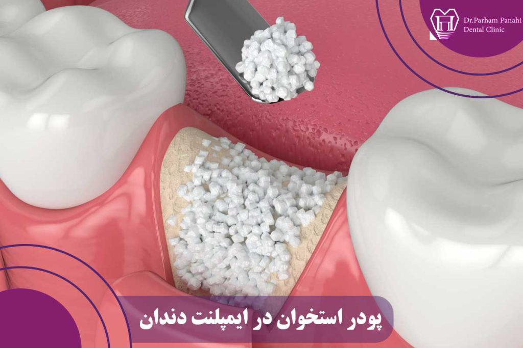 پودر استخوان در ایمپلنت دندان