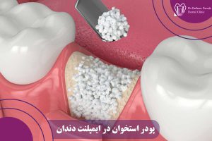 پودر استخوان در ایمپلنت دندان