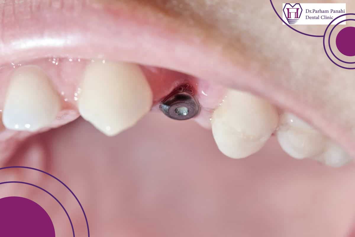 عوارض و مشکلات احتمالی هیلینگ ایمپلنت