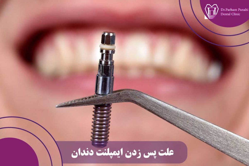 علت پس زدن ایمپلنت دندان