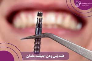 علت پس زدن ایمپلنت دندان