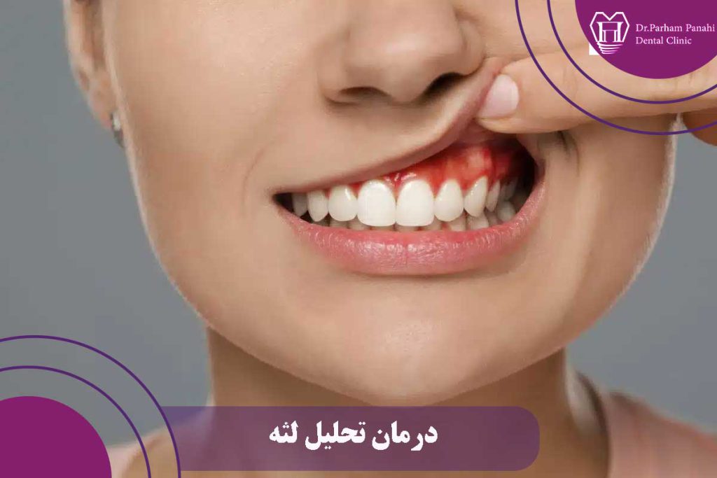 درمان تحلیل لثه