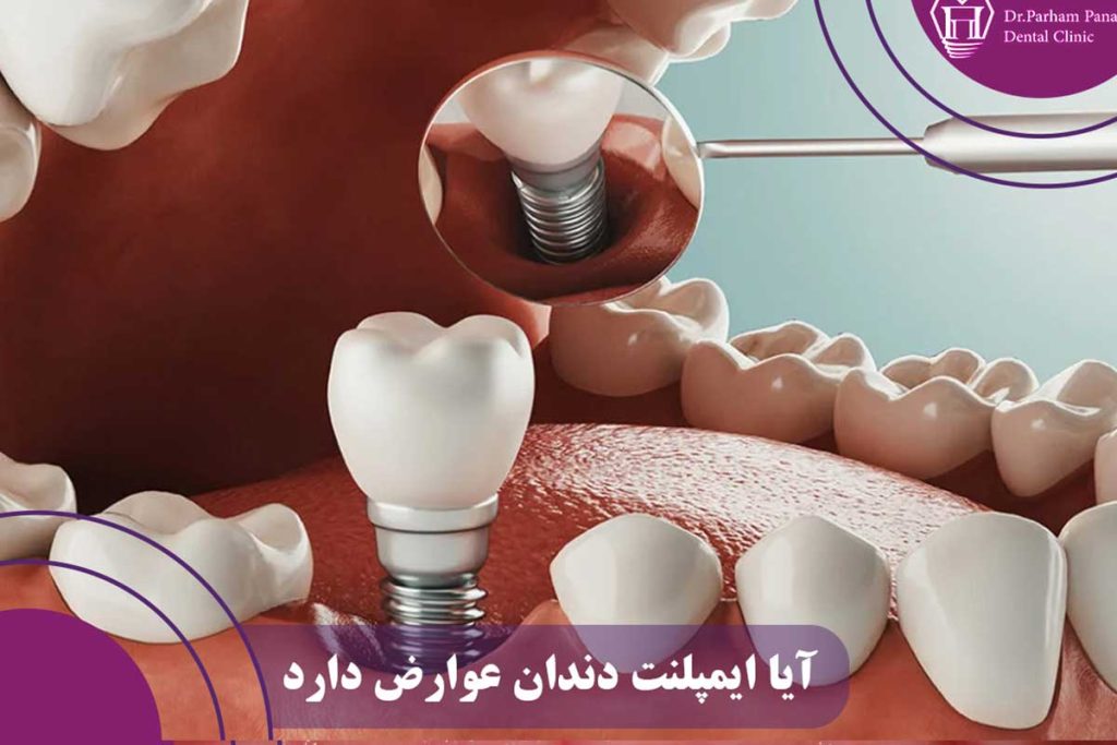 عوارض ایمپلنت