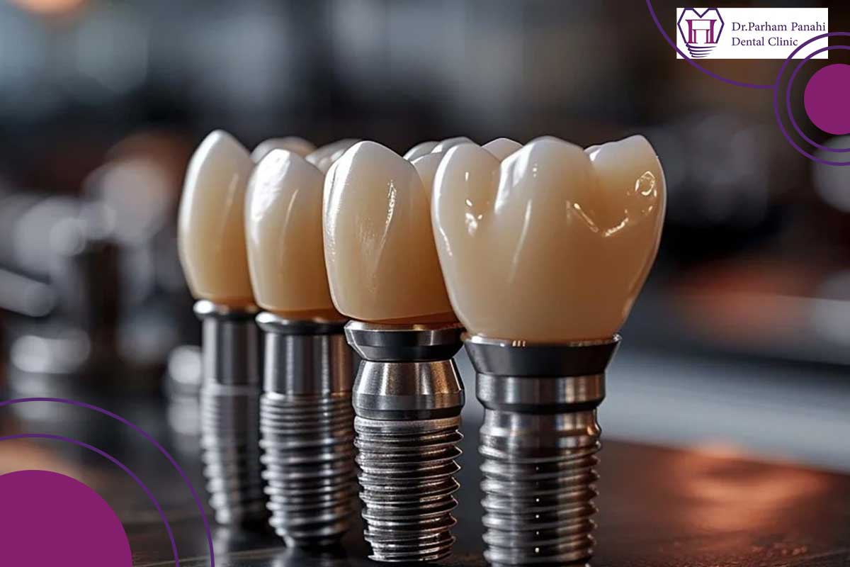 ایمپلنت آلمانی