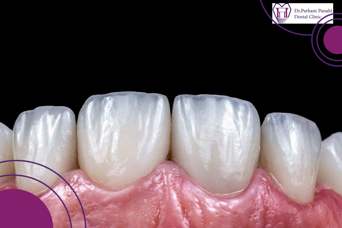 داستان یک تغییر بزرگ: تجربه لمینت ایمکس در تبریز