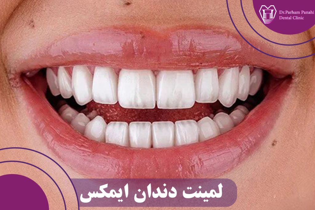 لمینت دندان ایمکس