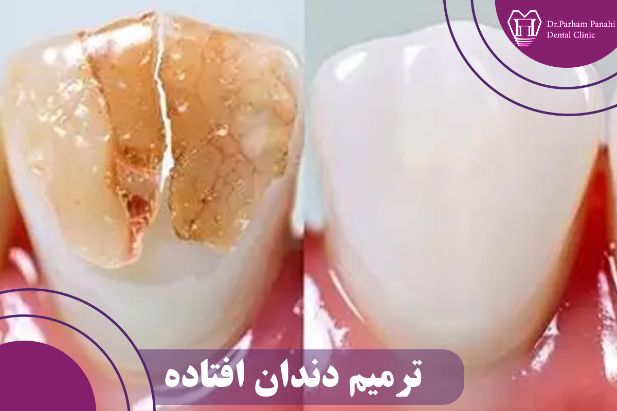 چرا دندان‌ها ناگهان فرو می‌ریزند؟ (کالبدشکافی یک اتفاق پنهان)