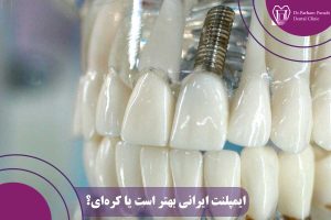 ایمپلنت ایرانی بهتر است یا کرهای؟