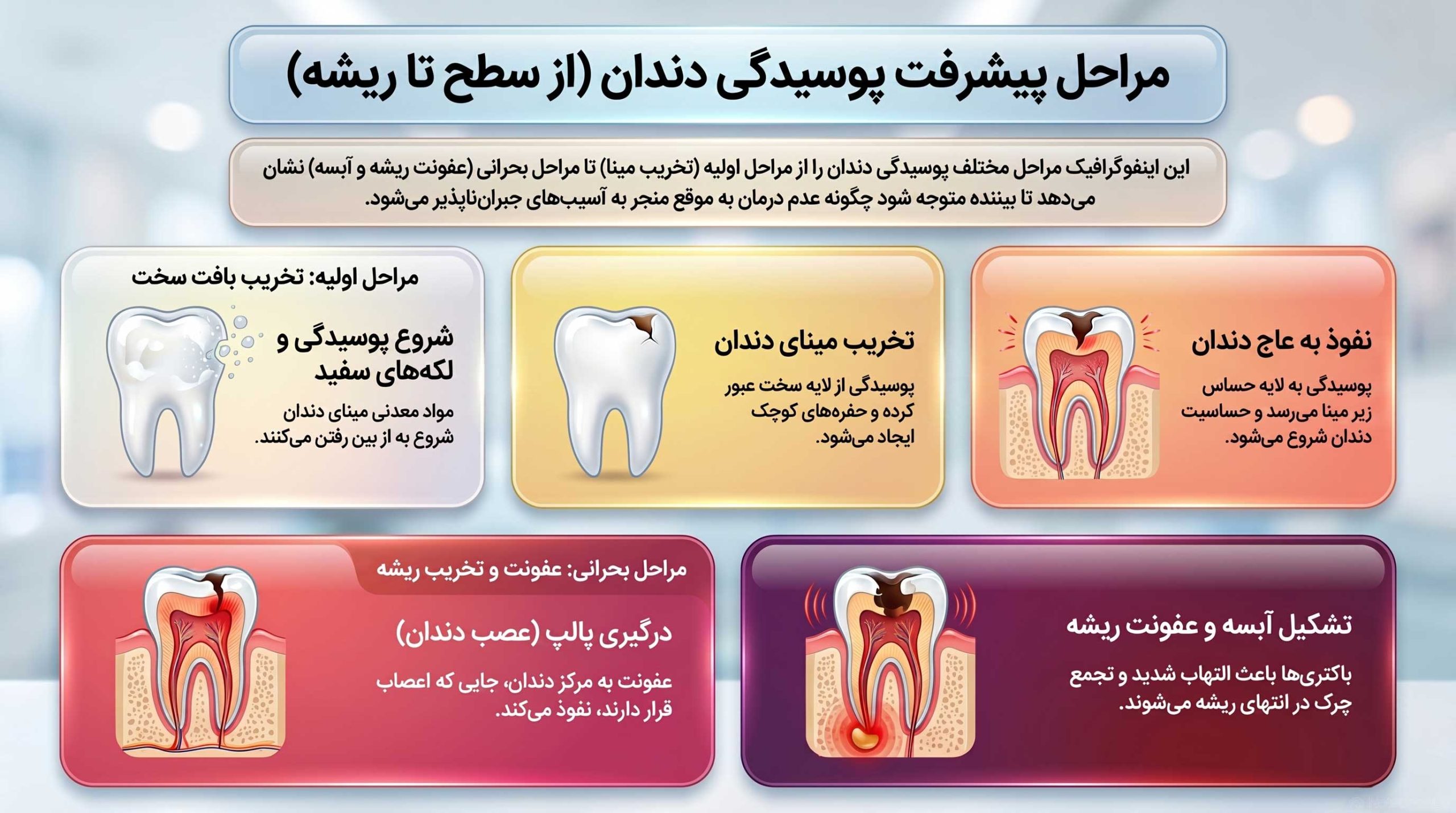 مراحل پوسیدگی دندان
